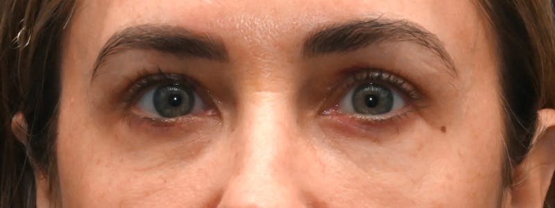 Eyelid Surgery Before & After Gallery - Patient 172420 - Image 2
