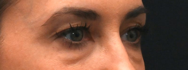 Eyelid Surgery Before & After Gallery - Patient 172420 - Image 5