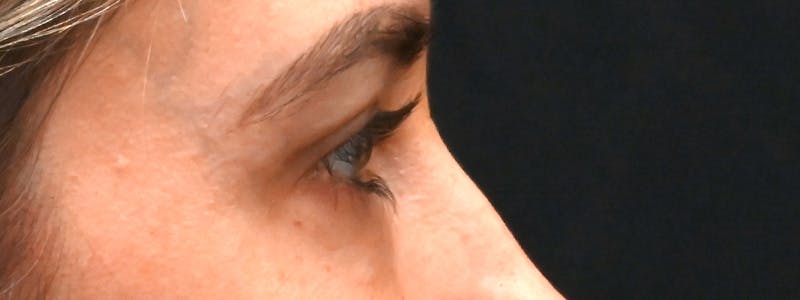 Eyelid Surgery Before & After Gallery - Patient 172420 - Image 8