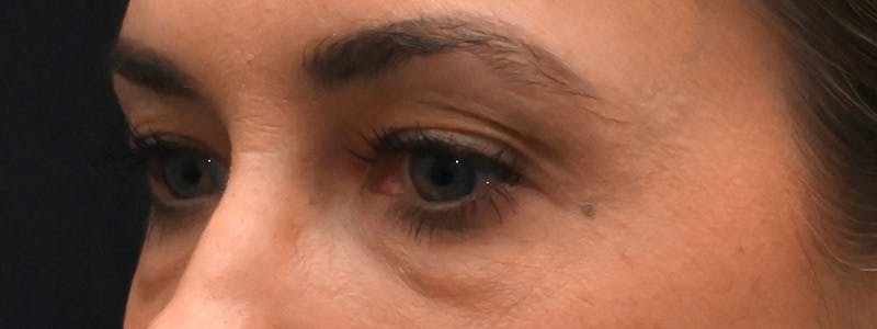 Eyelid Surgery Before & After Gallery - Patient 172420 - Image 9
