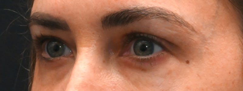 Eyelid Surgery Before & After Gallery - Patient 172420 - Image 10