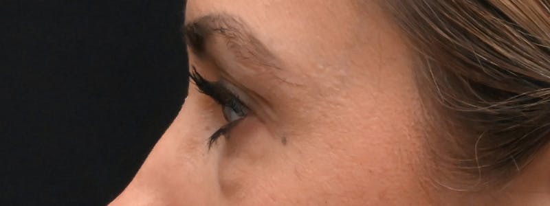 Eyelid Surgery Before & After Gallery - Patient 172420 - Image 11