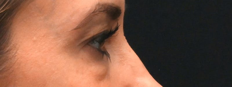 Eyelid Surgery Before & After Gallery - Patient 172420 - Image 7