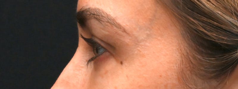 Eyelid Surgery Before & After Gallery - Patient 172420 - Image 12