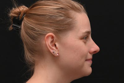 Rhinoplasty Before & After Gallery - Patient 145553 - Image 2