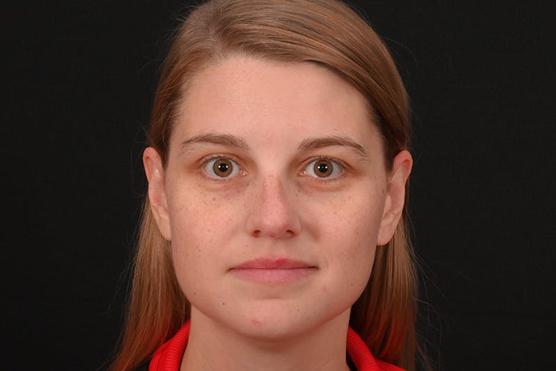 Rhinoplasty Before & After Gallery - Patient 145553 - Image 5