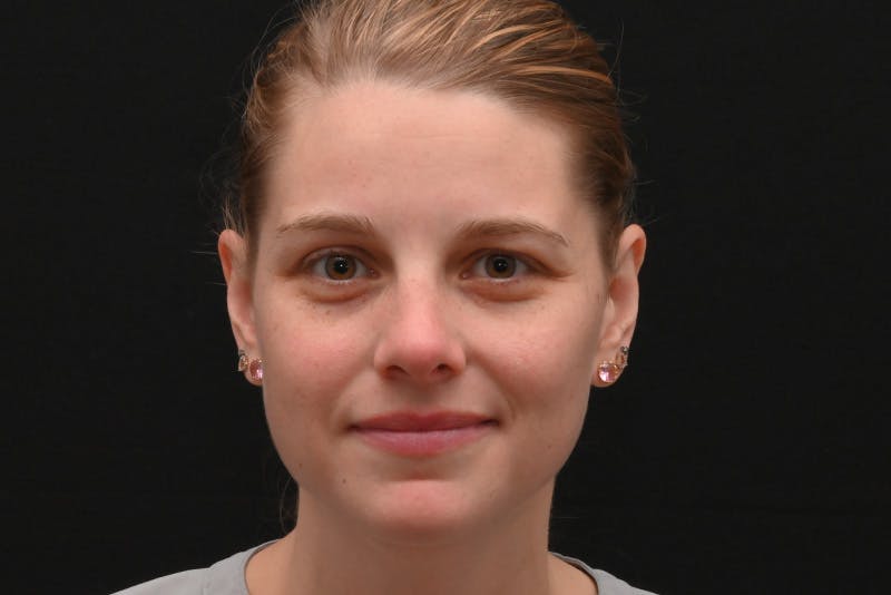 Rhinoplasty Before & After Gallery - Patient 145553 - Image 6