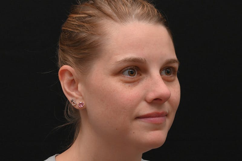 Rhinoplasty Before & After Gallery - Patient 145553 - Image 4
