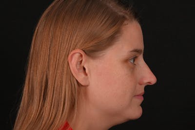 Rhinoplasty Before & After Gallery - Patient 145553 - Image 1