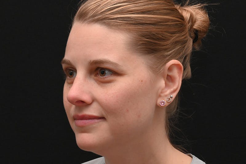 Rhinoplasty Before & After Gallery - Patient 145553 - Image 8