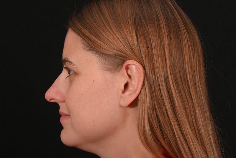 Rhinoplasty Before & After Gallery - Patient 145553 - Image 9