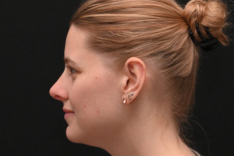 Rhinoplasty Before & After Gallery - Patient 145553 - Image 10