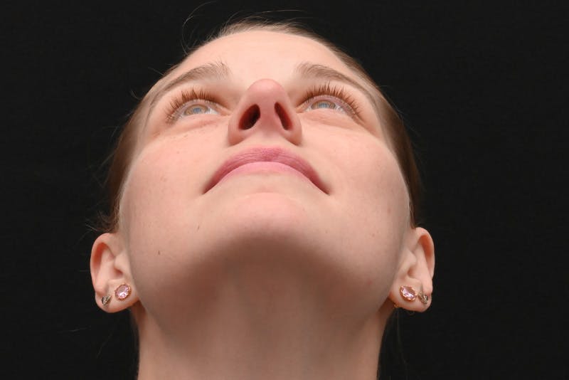 Rhinoplasty Before & After Gallery - Patient 145553 - Image 12