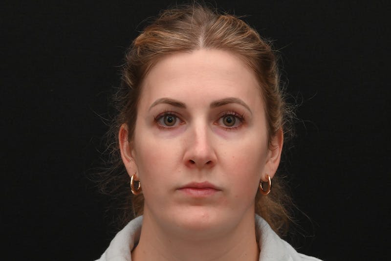Rhinoplasty Before & After Gallery - Patient 191695 - Image 5