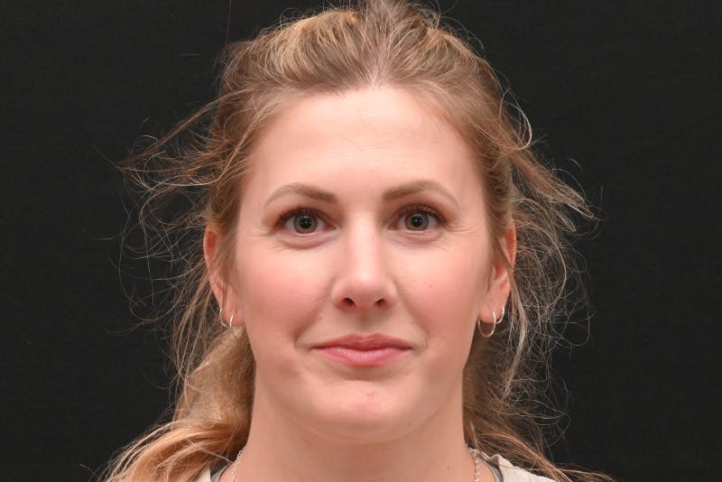 Rhinoplasty Before & After Gallery - Patient 191695 - Image 6