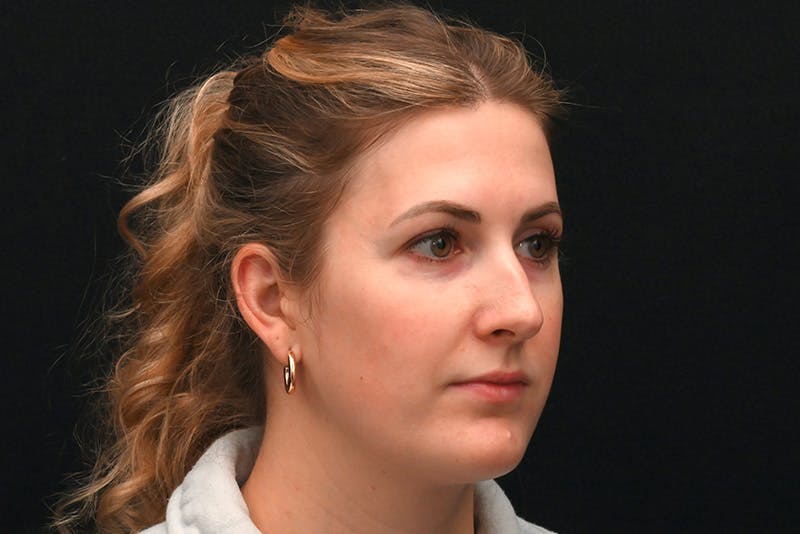 Rhinoplasty Before & After Gallery - Patient 191695 - Image 3