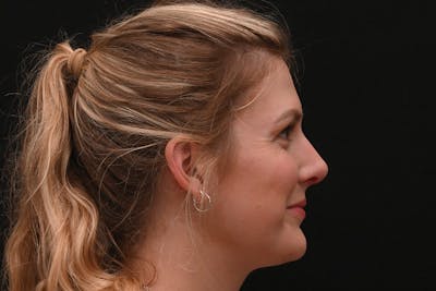 Rhinoplasty Before & After Gallery - Patient 191695 - Image 2