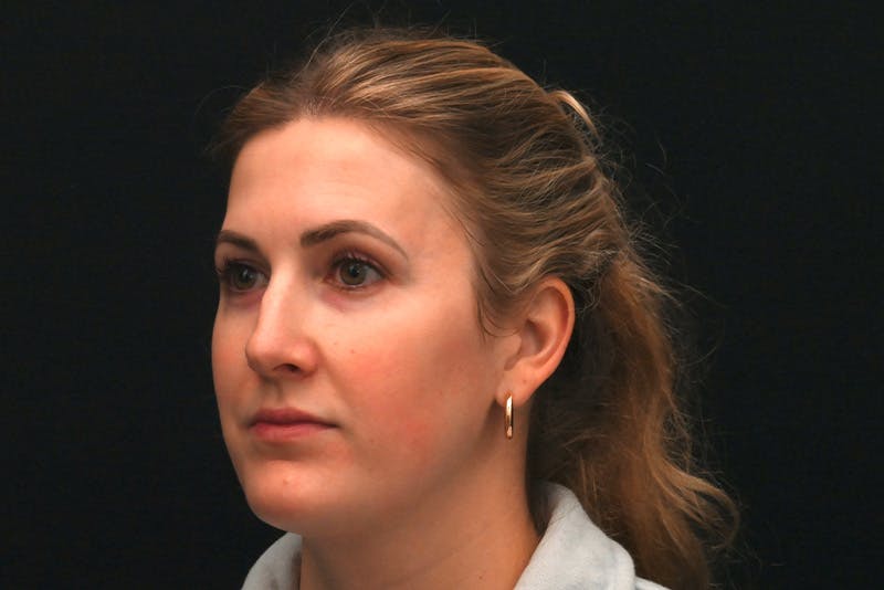 Rhinoplasty Before & After Gallery - Patient 191695 - Image 7