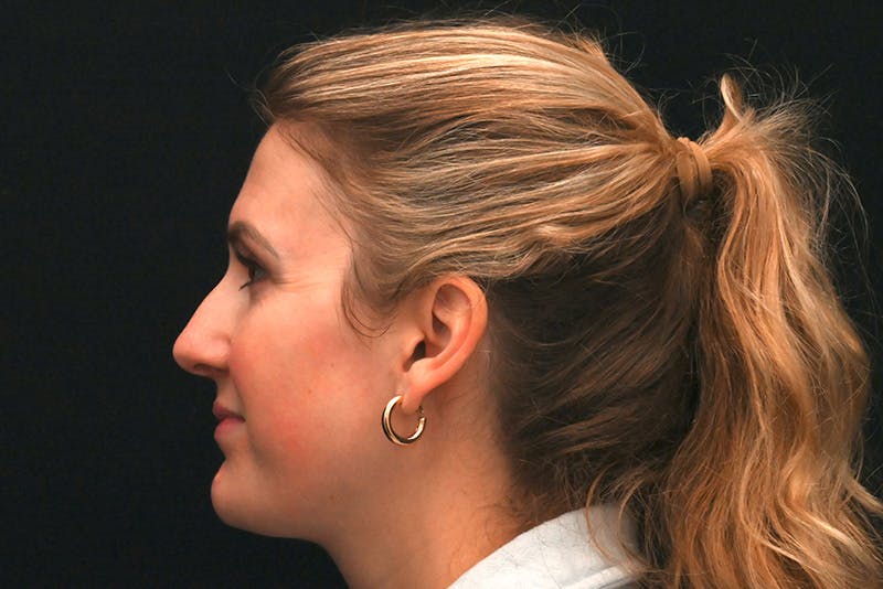 Rhinoplasty Before & After Gallery - Patient 191695 - Image 9