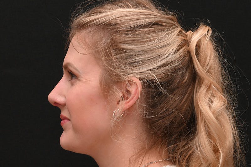 Rhinoplasty Before & After Gallery - Patient 191695 - Image 10