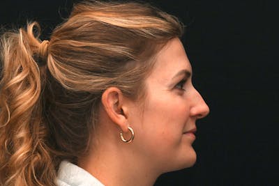 Rhinoplasty Before & After Gallery - Patient 191695 - Image 1