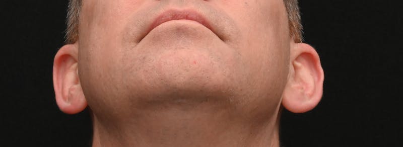 Otoplasty Before & After Gallery - Patient 343535 - Image 3