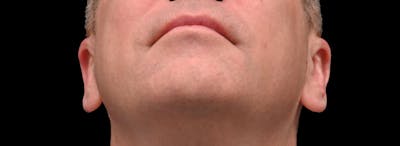 Otoplasty Before & After Gallery - Patient 343535 - Image 2