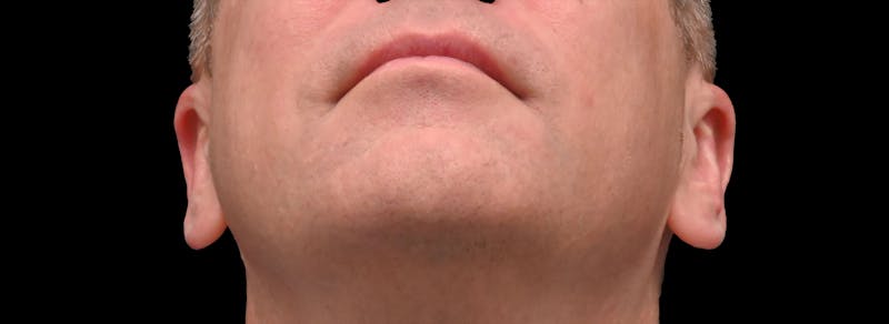Otoplasty Before & After Gallery - Patient 343535 - Image 4
