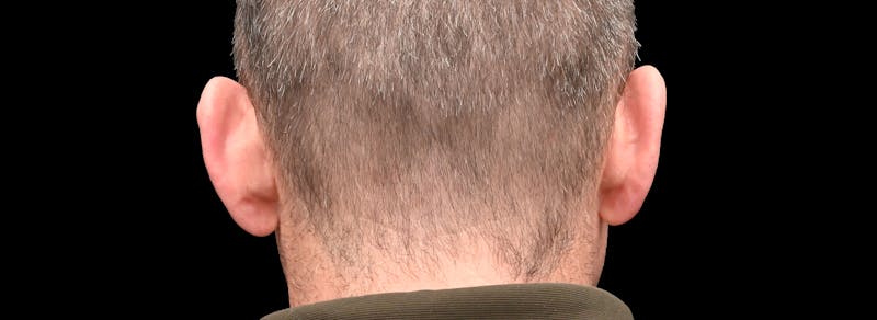Otoplasty Before & After Gallery - Patient 343535 - Image 5