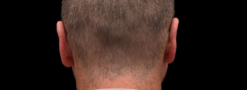 Otoplasty Before & After Gallery - Patient 343535 - Image 6