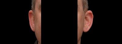 Otoplasty Before & After Gallery - Patient 343535 - Image 1
