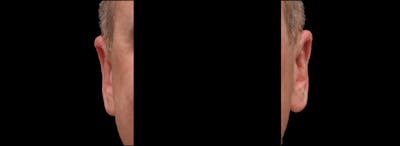 Otoplasty Before & After Gallery - Patient 343535 - Image 2