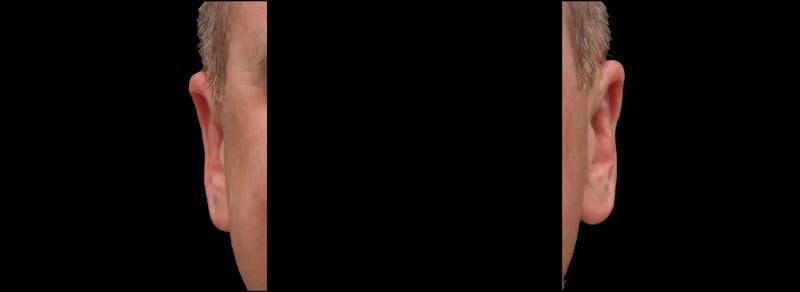 Otoplasty Before & After Gallery - Patient 343535 - Image 2