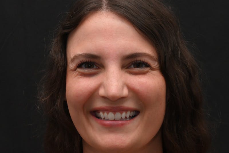 Rhinoplasty Before & After Gallery - Patient 406607 - Image 6
