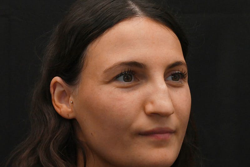 Rhinoplasty Before & After Gallery - Patient 406607 - Image 3