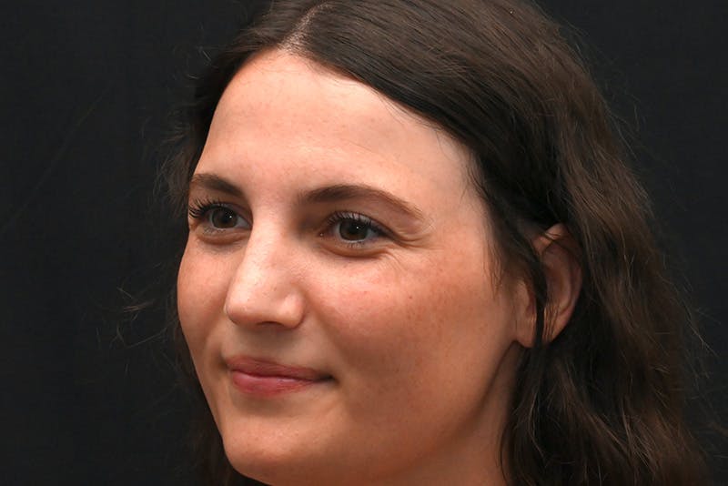 Rhinoplasty Before & After Gallery - Patient 406607 - Image 8