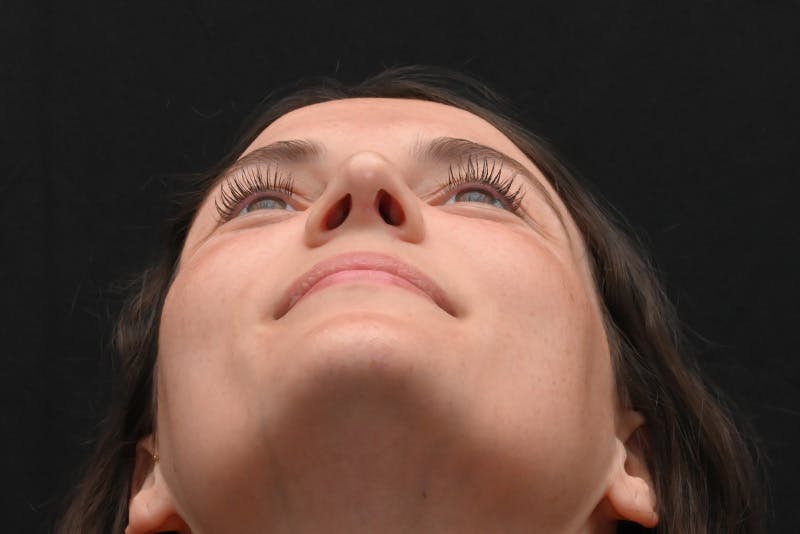 Rhinoplasty Before & After Gallery - Patient 406607 - Image 12