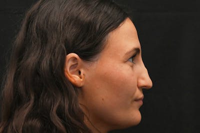 Rhinoplasty Before & After Gallery - Patient 406607 - Image 1