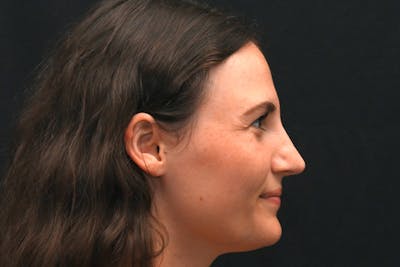 Rhinoplasty Before & After Gallery - Patient 406607 - Image 2