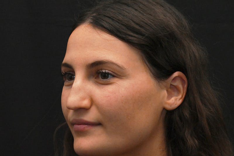 Rhinoplasty Before & After Gallery - Patient 406607 - Image 7