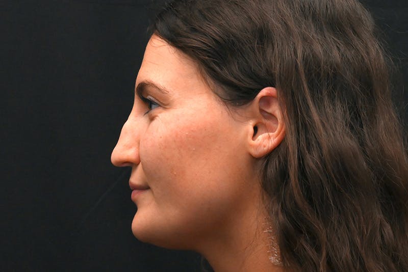 Rhinoplasty Before & After Gallery - Patient 406607 - Image 9