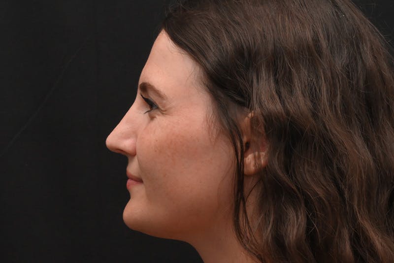 Rhinoplasty Before & After Gallery - Patient 406607 - Image 10