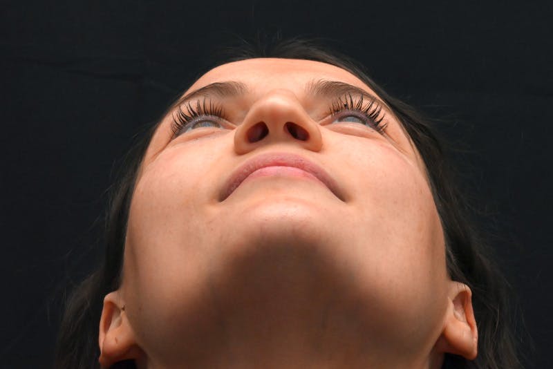 Rhinoplasty Before & After Gallery - Patient 406607 - Image 11