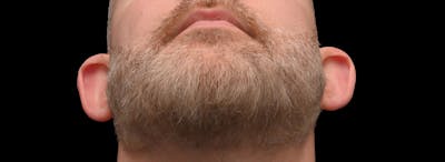 Otoplasty Before & After Gallery - Patient 199337 - Image 1