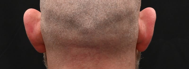 Otoplasty Before & After Gallery - Patient 199337 - Image 5