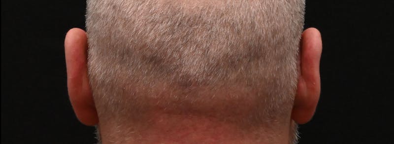 Otoplasty Before & After Gallery - Patient 199337 - Image 6