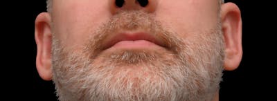 Otoplasty Before & After Gallery - Patient 199337 - Image 2