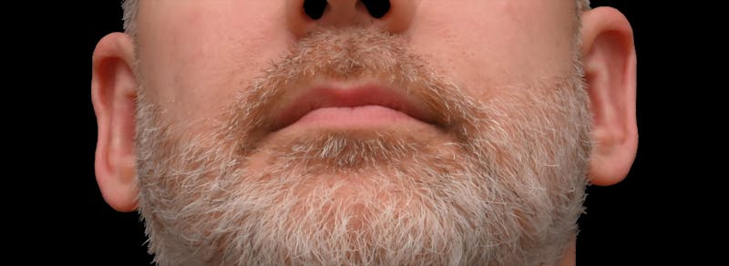 Otoplasty Before & After Gallery - Patient 199337 - Image 2