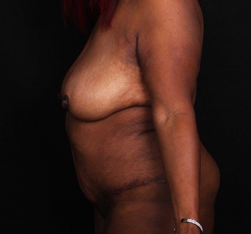 Abdominoplasty Before & After Gallery - Patient 301814 - Image 6