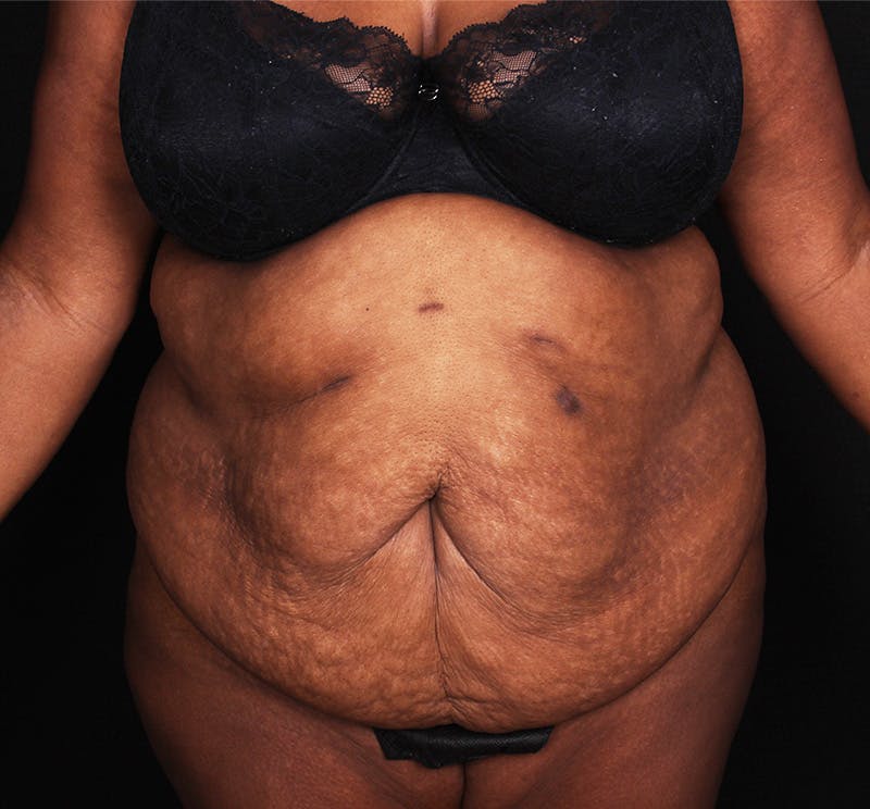 Abdominoplasty Before & After Gallery - Patient 301814 - Image 1